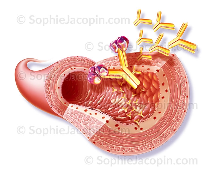 Illustration medicale _ Specialite medicale-Maladie de Crohn Illustration medicale _ Specialite medicale-Maladie de Crohn