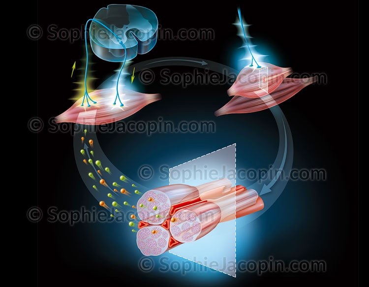 Illustration medicale _ Specialités medicales-Crampe musculaire Illustration medicale _ Specialités medicales-Crampe musculaire