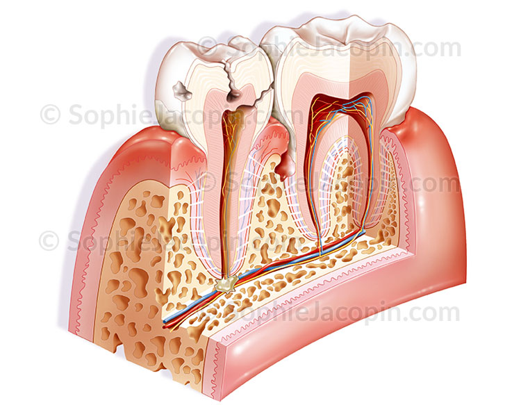 Illustration medicale_Pathologies dents