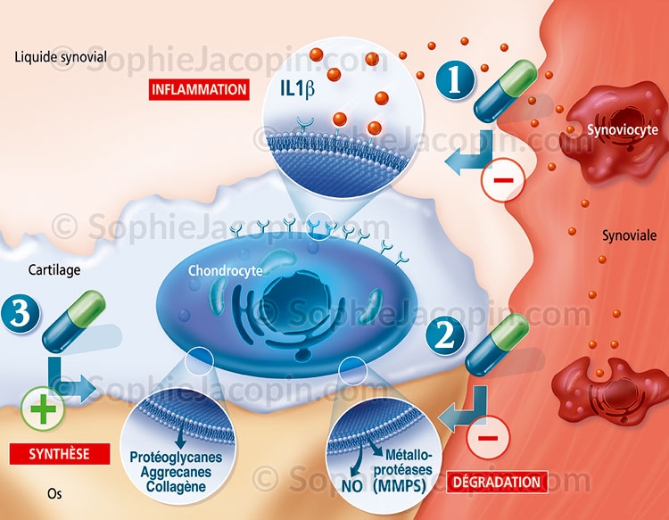 Illustration medicale _ Spécialités medicales-Traitement arthrose genou Illustration medicale _ Spécialités medicales-Traitement arthrose genou