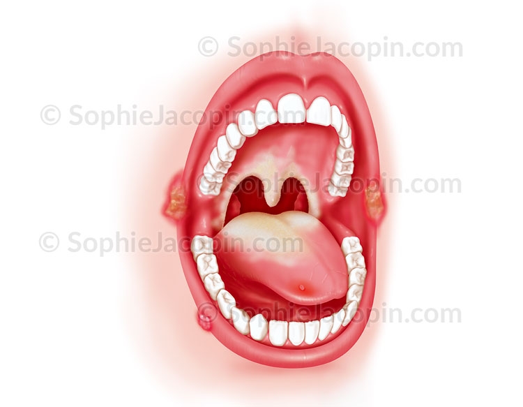 Illustration medicale _ Spécialité médicale-Pathologie bouche Illustration medicale _ Spécialité médicale-Pathologie bouche
