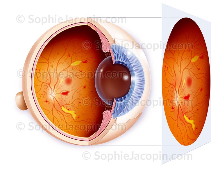 Illustration medicale _ Specialite-medicale-Retinopathie Illustration medicale _ Specialite-medicale-Retinopathie