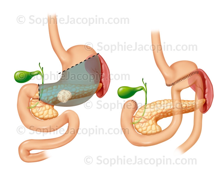 Illustration medicale _ Specialités medicales-Gastrectomie partielle Illustration medicale _ Specialités medicales-Gastrectomie partielle