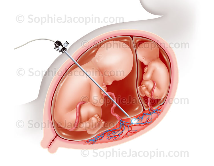Illustration medicale_Chirurgie foetale