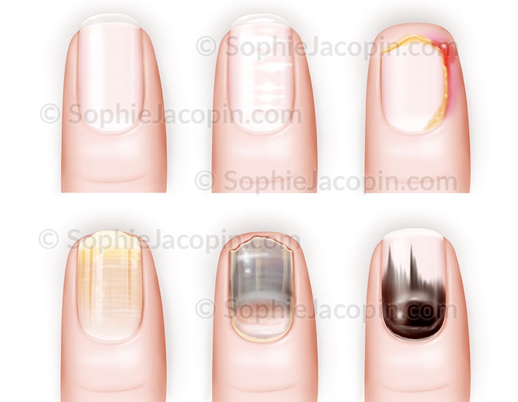 Illustration medicale _ Specialites medicales-Pathologies des ongles Illustration medicale _ Specialites medicales-Pathologies des ongles