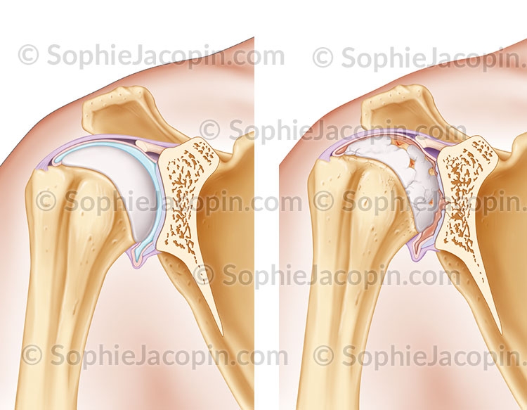 Anatomie  arthrose de l'épaule Illustration médicale - Anatomie  arthrose épaule