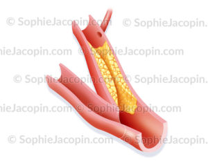 Pontage coronarien, greffe (vaisseau à gauche) d'un vaisseau au delà de la zone atteinte de l'artère bouchée par une plaque d'athérome - © sophie jacopin