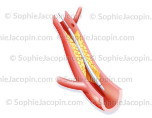 Angioplastie par ballonnet, chirurgie coronarienne - © sophie jacopin