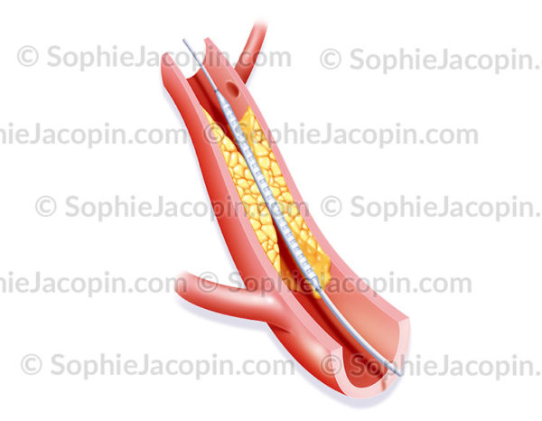 Angioplastie par endoprothèse, première étape de l'intervention chirurgicale. On introduit un cathéter équipé d'un stent (sorte de ressort) -© sophie jacopin