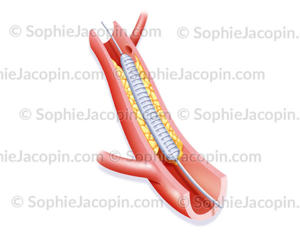 Angioplastie par endoprothèse, deuxième étape de l'intervention chirurgicale. - © sophie jacopin