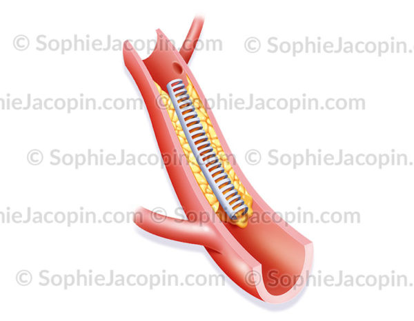 Angioplastie par endoprothèse, 3ème étape de l'intervention chirurgicale - © sophie jacopin
