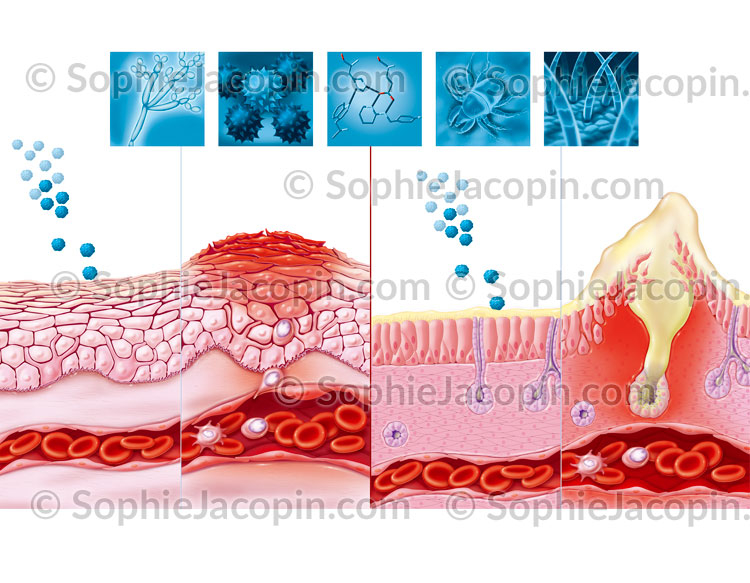 Réactions allergiques - Illustration Médicale - © Sophie Jacopin