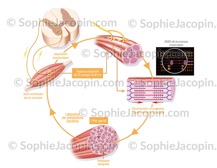 CRAMPE MUSCULAIRE - illustration-medicale.com - Sophie Jacopin