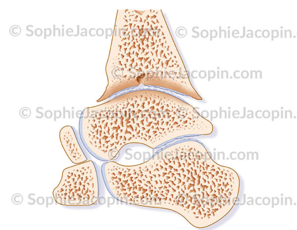 Arthropathie hémophilique de la cheville sur une coupe sagittale médiane - © sophie jacopin