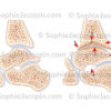 Arthropathie hémophilique de la cheville et comparaison avec une articulation saine - © sophie jacopin