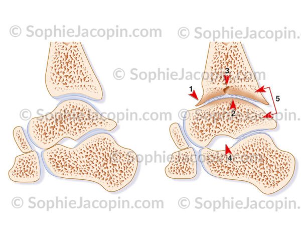 Arthropathie hémophilique de la cheville et comparaison avec une articulation saine - © sophie jacopin