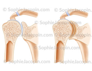 Arthropathie hémophilique épaule et comparaison avec une articulation saine - © sophie jacopin