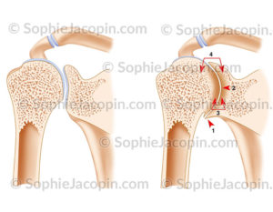 Arthropathie hémophilique épaule et comparaison avec une articulation saine - c sophie jacopin