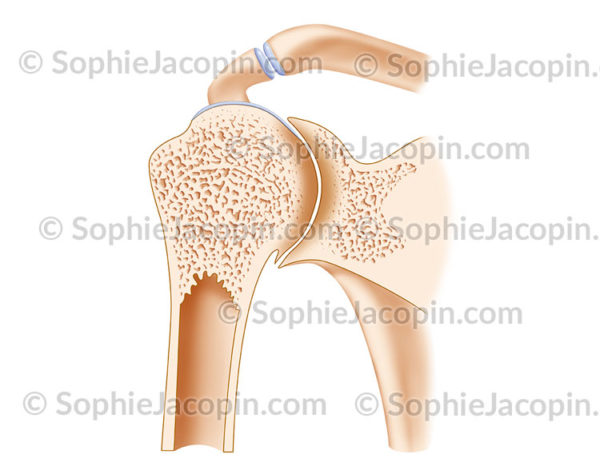 Arthropathie hémophilique épaule en cope frontale - © sophie jacopin
