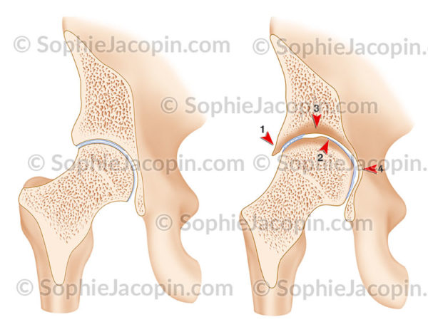 Arthropathie hémophilique hanche er articulation saine - © sophie jacopin