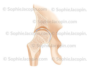 Arthropathie hémophilique hanche en coupe frontale - © sophie jacopin