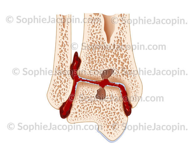 Arthropathie hémophilique au niveau de la cheville - © sophie jacopin