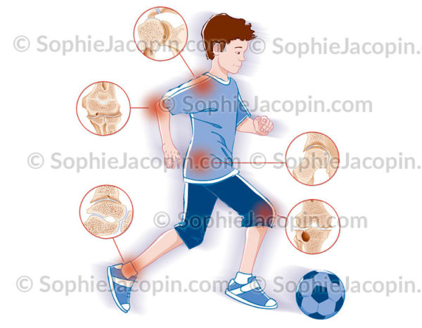 Arthropathie hémophilique, épaule, coude, hanche, genou, cheville - © sophie jacopin