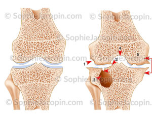 Arthropathie hémophilique du genou et comparaison avec une articulation saine - © sophie jacopin