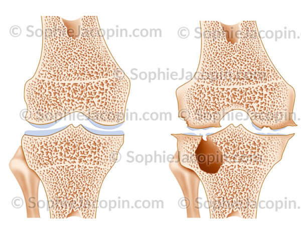 Arthropathie hémophilique du genou en coupe frontale - © sophie jacopin