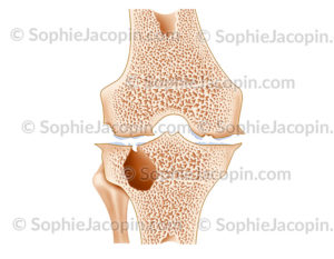 Arthropathie hémophilique du genou, pathologie de l'articulation chez un hémophile. - c sophie jacopin