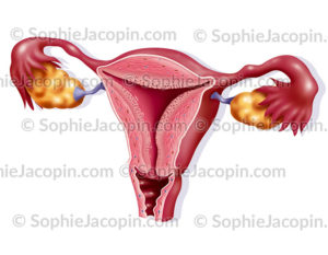 Utérus ovaires