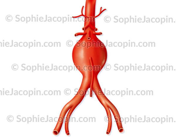 Anévrisme de l'aorte sous rénale - © sophie jacopin