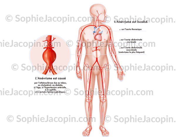 Anévrisme de l'aorte sous rénale - © sophie jacopin