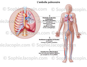 Embolie pulmonaire