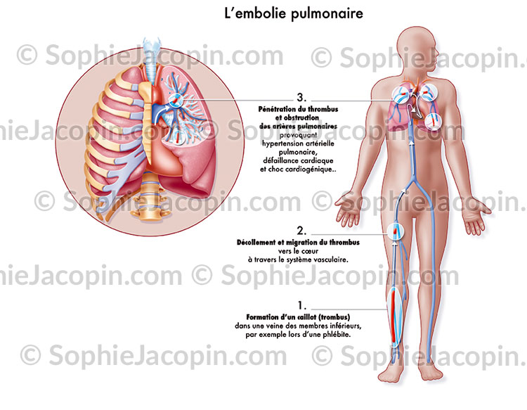Embolie pulmonaire