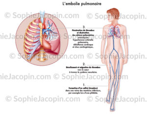 Embolie pulmonaire