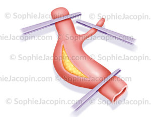 Endartériectomie, chirurgie coronarienne - © sophie jacopin