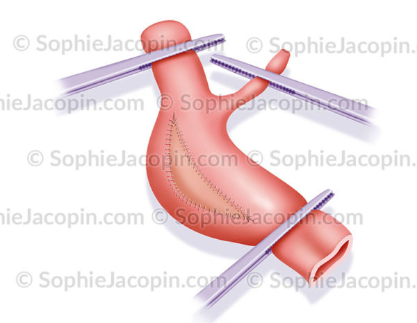 Endartériectomie, chirurgie coronarienne - © sophie jacopin