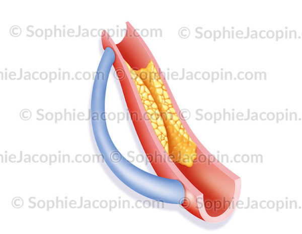 Pontage artériel, chirurgie coronarienne - © sophie jacopin