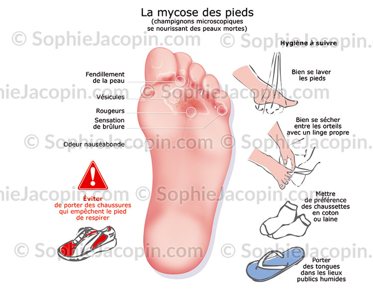 MYCOSE DES PIEDS - illustration-medicale.com - Sophie Jacopin