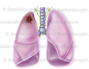 Cancer du poumon, tumeur cancéreuse - © sophie jacopin