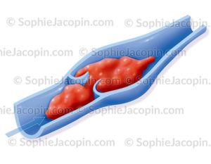 Caillot sanguin, thrombus, pathologie du retour veineux - © sophie jacopin