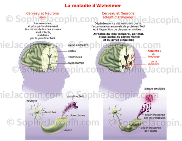 Alzheimer, Coupe frontale du cerveau remis en vue de 3/4 dans un visage d'homme âgé - © sophie jacopin