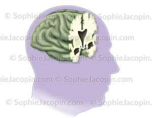 Alzheimer, Coupe frontale du cerveau remis en vue de 3/4 dans un visage d'homme âgé - © sophie jacopin