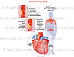 Infarctus du myocarde ou crise cardiaque, étapes de la formation et du déclenchement de la crise - C sophie jacopin