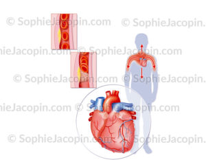 Infarctus du myocarde ou crise cardiaque, étapes de la formation et du déclenchement de la crise - © sophie jacopin