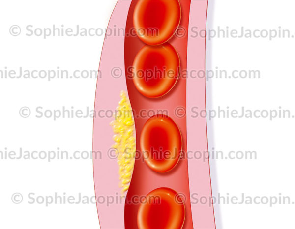 Plaque d'athérome formée sur la paroi interne d'une artère de gros calibre - © sophie jacopin