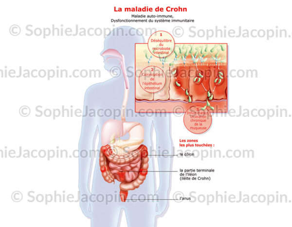 Maladie de Crohn, maladie auto-immune, localisation des zones touchées au niveau du côlon - © sophie jacopin