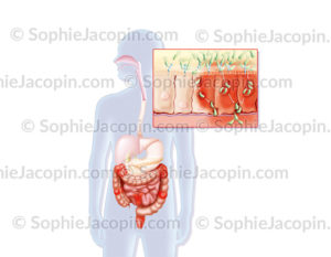 Maladie de Crohn, maladie auto-immune, localisation des zones touchées au niveau du côlon - © sophie jacopin