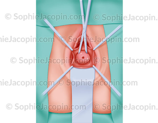 Hystérectomie par voie vaginale